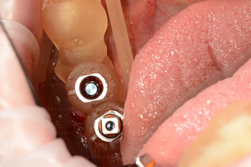Хирургические 3D шаблоны для имплантации зубов | Фото 1 - Стоматология Доброзуб