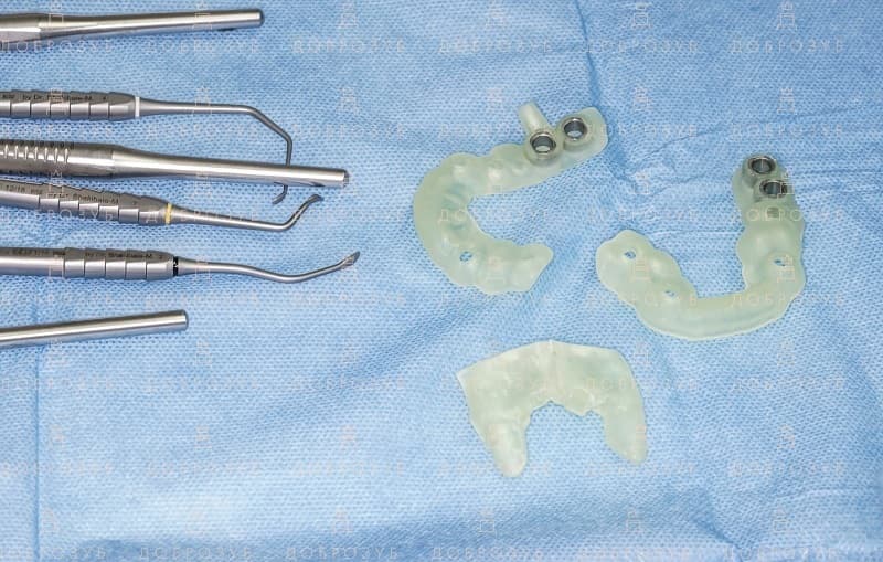 Хірургічні 3D шаблони для імплантації зубів | Фото 2 - Стоматологія Доброзуб