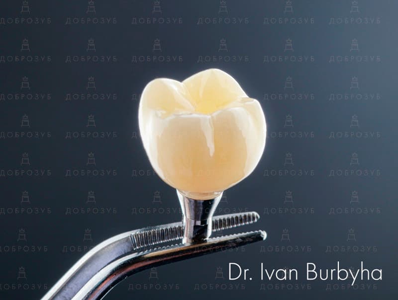 Имплантация зубов Киев | Фото-1 - Стоматология Доброзуб