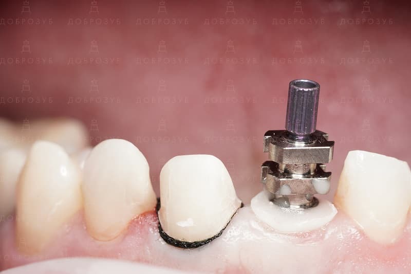 Implantation of teeth Photo 1 - Dobrozub Dentistry