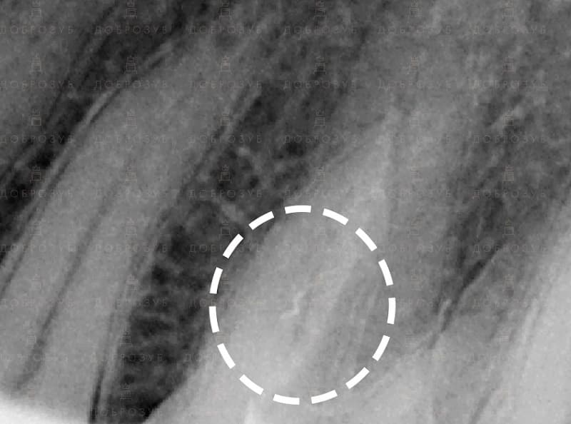 Лікування зубів під мікроскопом Фото 4/1 - Стоматологія Доброзуб.
