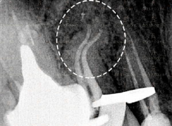 Лікування каналів зубів Київ | Фото 5 - Стоматологія Доброзуб