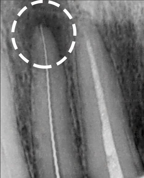 Лікування зубів під мікроскопом Фото 5 - Стоматологія Доброзуб.