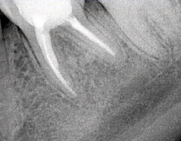 Лікування зубів під мікроскопом Фото 7 - Стоматологія Доброзуб.