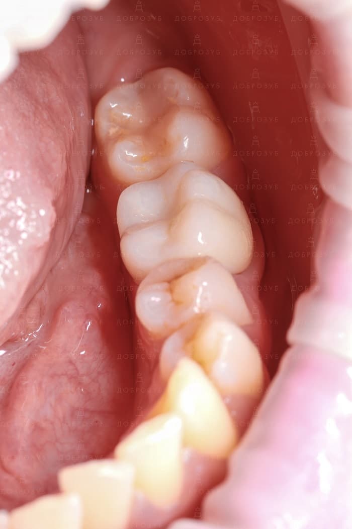 Implantation of teeth Photo 11 - Dentistry Dobrozub