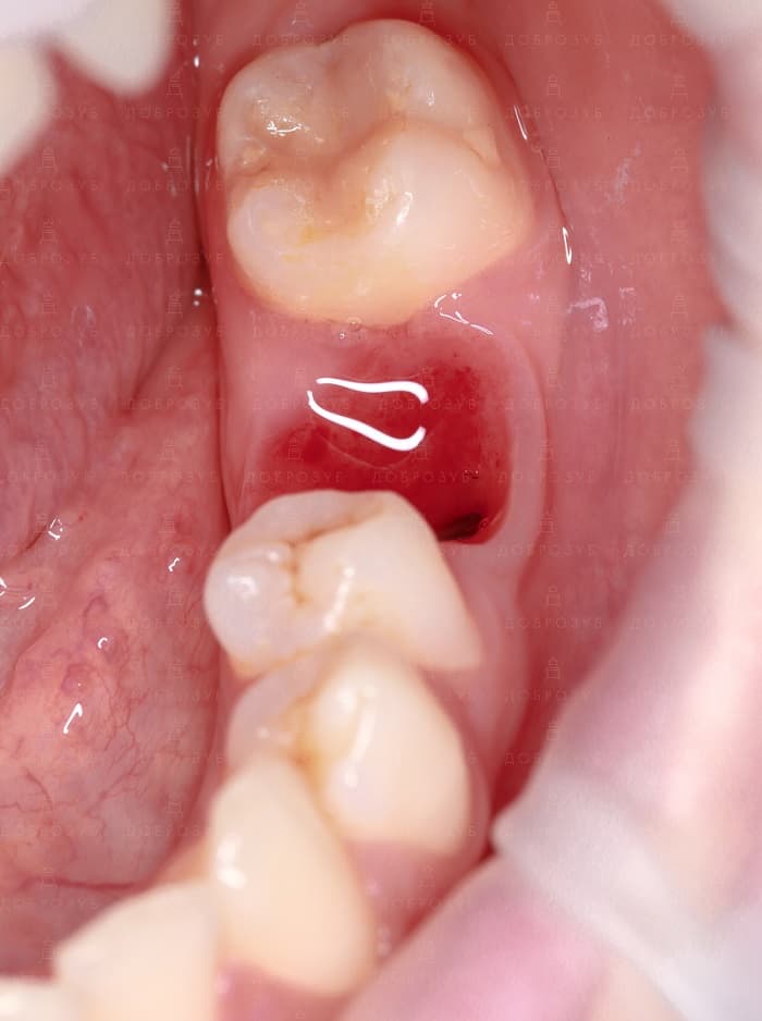 Implantation of teeth Photo 9 - Dentistry Dobrozub