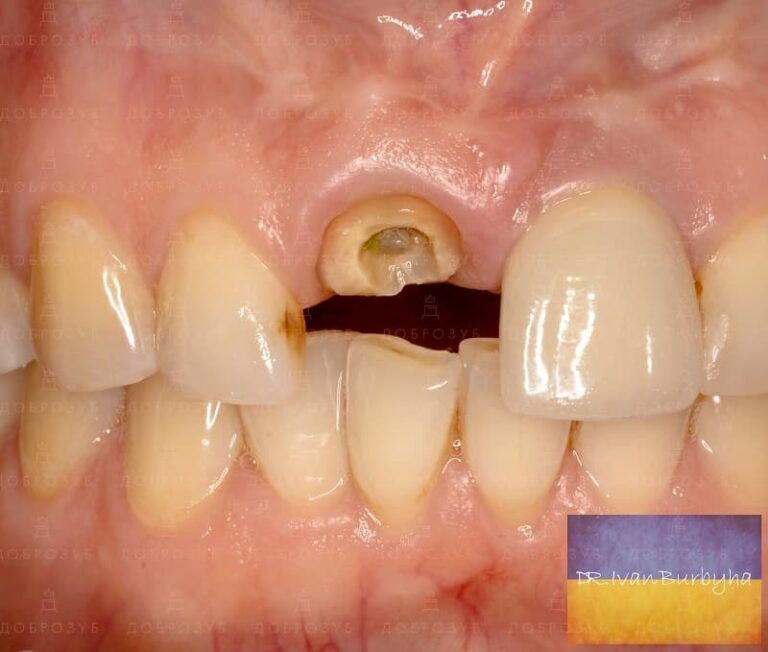 Megagen implants placement of Korean Megagen implants in Kyiv