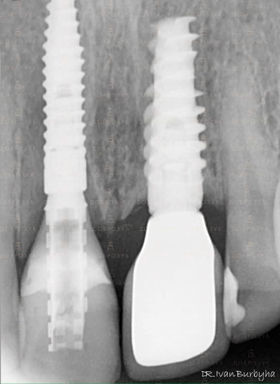 Implantation of teeth Photo 8 - Dentistry Dobrozub