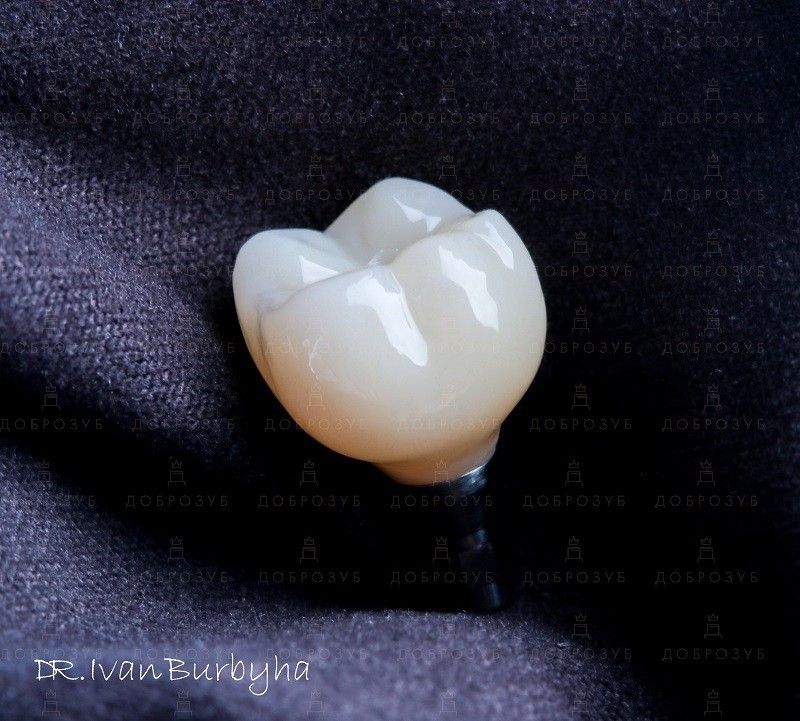 Implantation of teeth Photo 10 - Dentistry Dobrozub