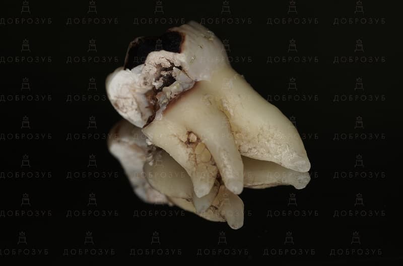 Удаление зуба Киев | Фото 5 - Стоматология Доброзуб