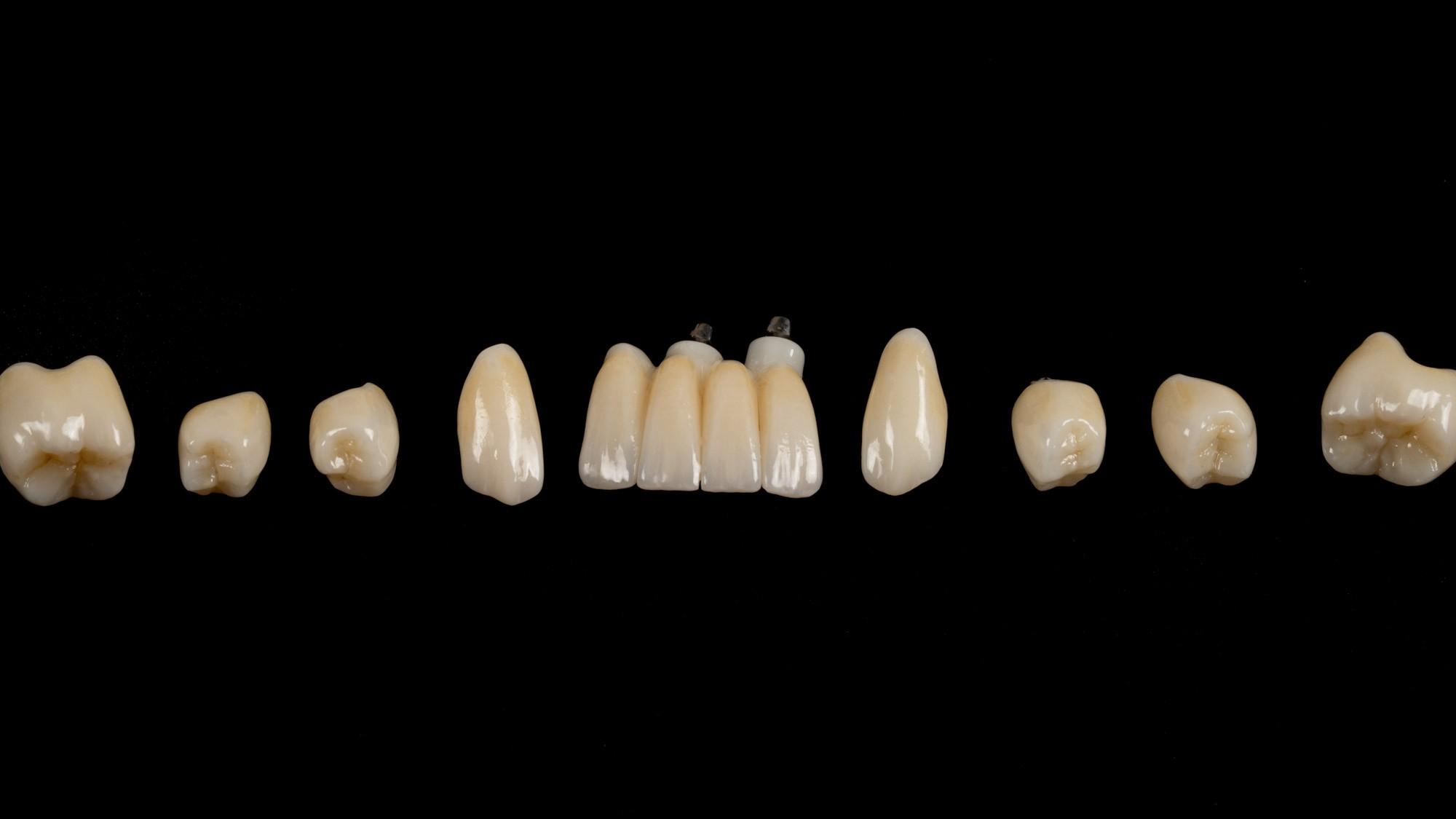 Имплант или коронка на зуб